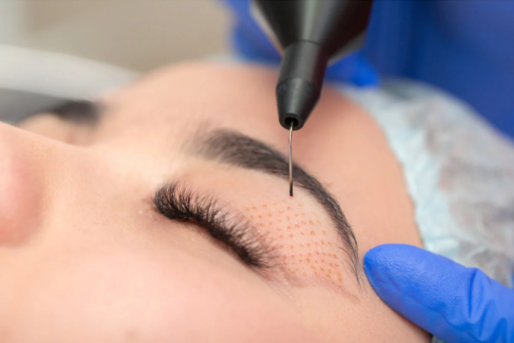 Plasma pen procedure on eyelid